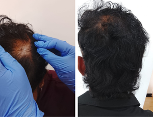  Hair Fall Treatment yelahanka bangalore