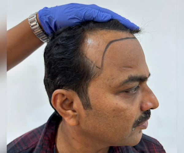 safe hair transplant at Perfect U