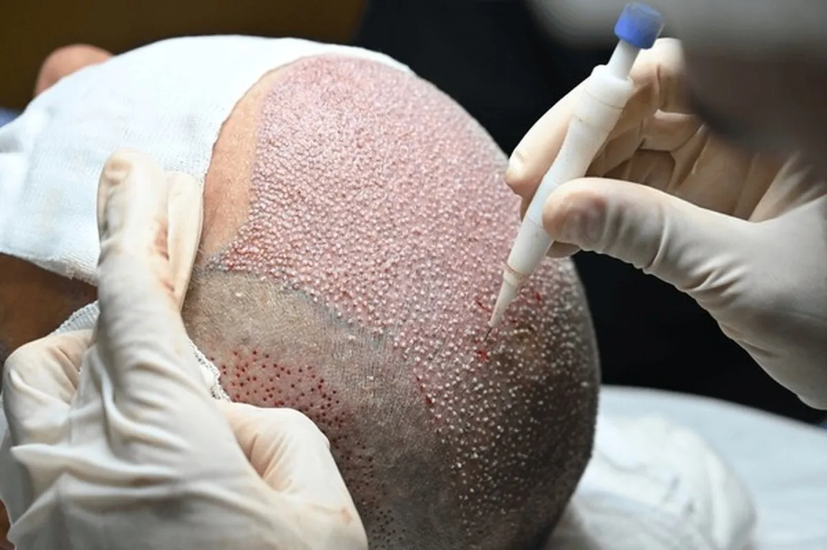 hair-transplant-surgery-restore-your-hair-confidence