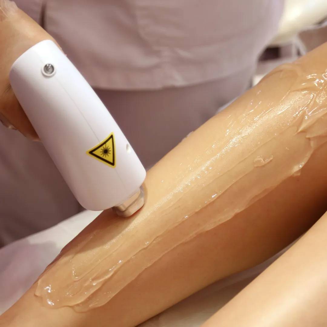 laser-hair-removal