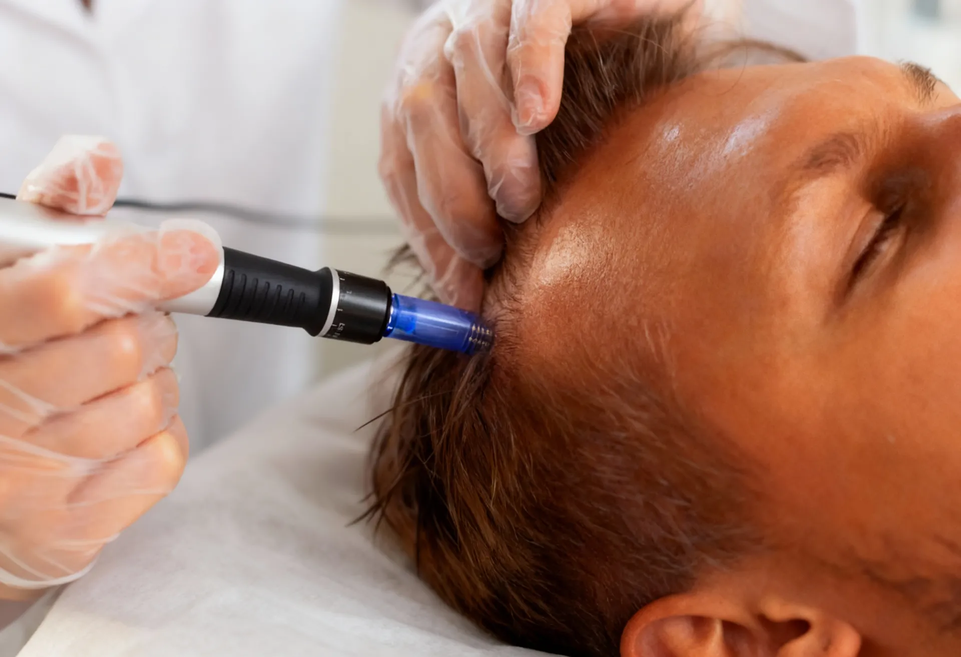 microneedling-with-growth-factor-for-hair-featured-image