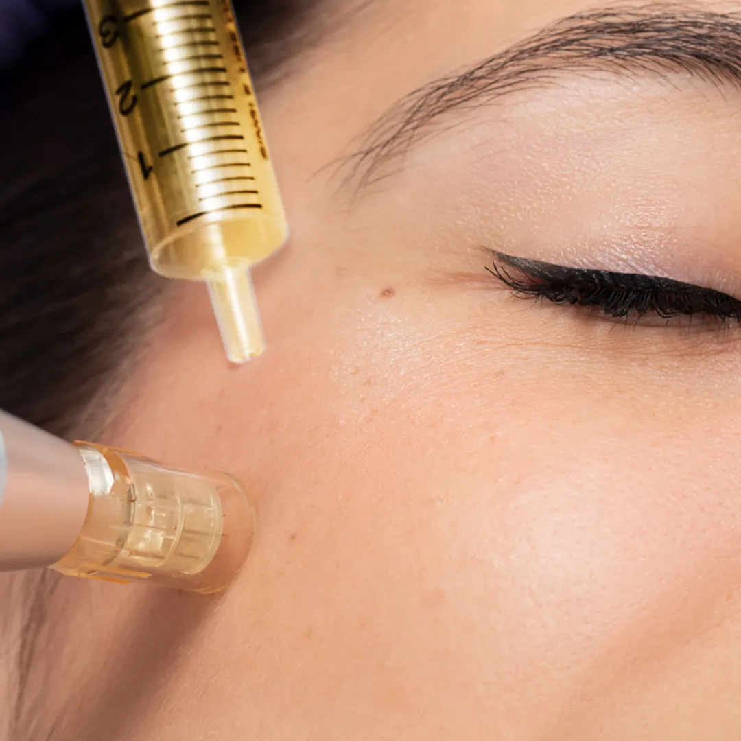 microneedling-with-prp